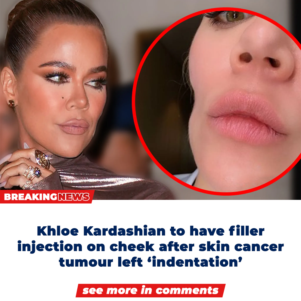 Khloe Kardashian to have filler injection on cheek after skin cancer ...